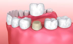 zubne krunice